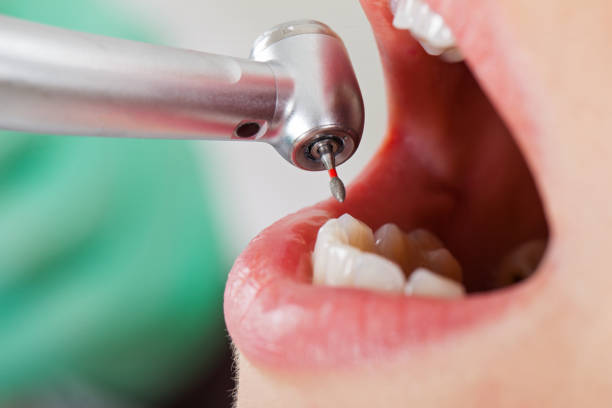 Best Emergency Root Canal Treatment in Willow Springs, MO